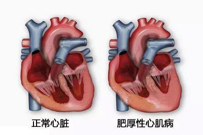 年輕人猝死多因這種心臟病！醫(yī)生提醒：一人發(fā)病全家篩查