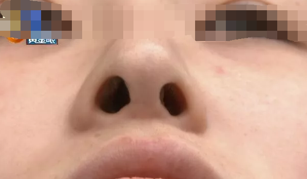 杭州千晴整形醫院隆鼻后耳后根長了個包 鼻孔也一大一小