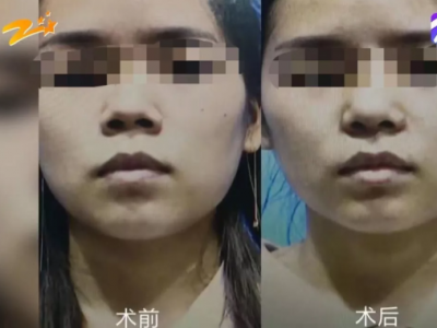 杭州甄美整形醫(yī)院把人鼻子整歪了？醫(yī)院：自己長歪了