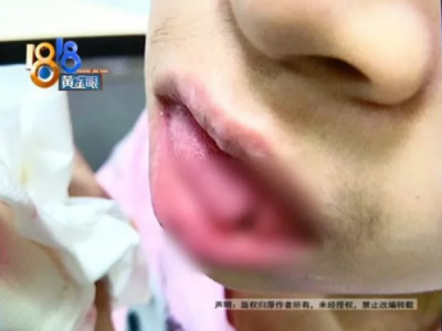去杭州艾維口腔補(bǔ)牙舌頭被劃傷縫八針 疼的渾身發(fā)抖