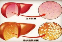 從脂肪肝到肝癌只需4步！做錯(cuò)這6件事，最容易得脂肪肝！