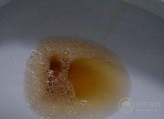 尿液發黃像濃茶？小心是肝膽出了問題！