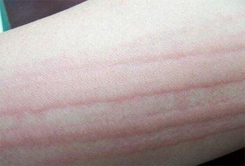 劃痕性蕁麻疹身體需要補充哪些營養