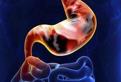 胃炎患者遇到這四種食物一定要忌口