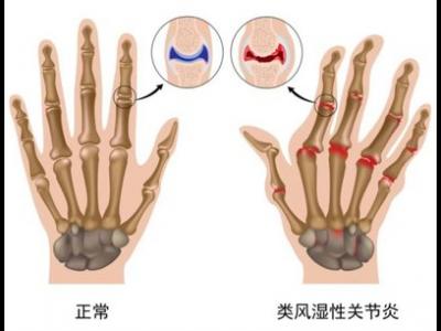 類風(fēng)濕關(guān)節(jié)炎高發(fā)人群存在著哪些特性