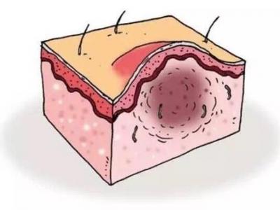毛囊炎反復發作的原因以及治療方法