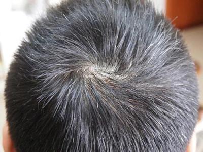 為什么會有人未老頭發先白的情況發生