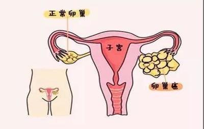 女人一旦有這三個特征就是卵巢癌候選人