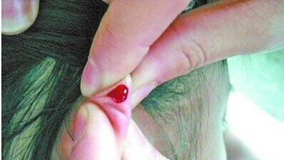 放血療法的效果放血療法可以治療哪些疾病