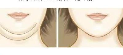 減雙下巴的運(yùn)動(dòng)方式