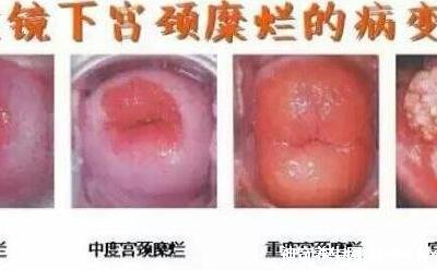 宮頸糜爛一二三度圖片，真實對比照片(小心是宮頸癌前兆)