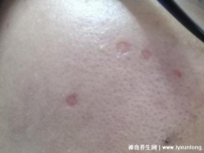 千萬不要激光點痣后悔一輩子，可導(dǎo)致惡性黑色素瘤(共3個危害)