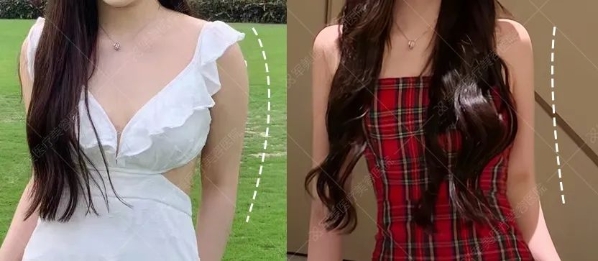 想吸脂后美美穿比基尼，這3大細節要注意