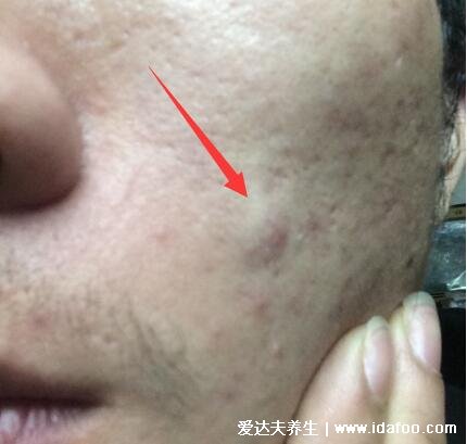 暗瘡圖片是什么樣子，暗瘡和痤瘡有區(qū)別(不形成膿包)