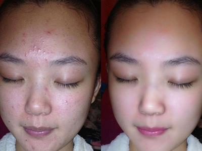女性長膿包型痤瘡怎么治理，紅腫膿皰護理不當容易留痘疤