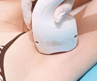 激光脫毛有用嗎？激光脫毛是永久性的嗎？