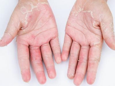 冬季手腳脫皮？找到4種原因
