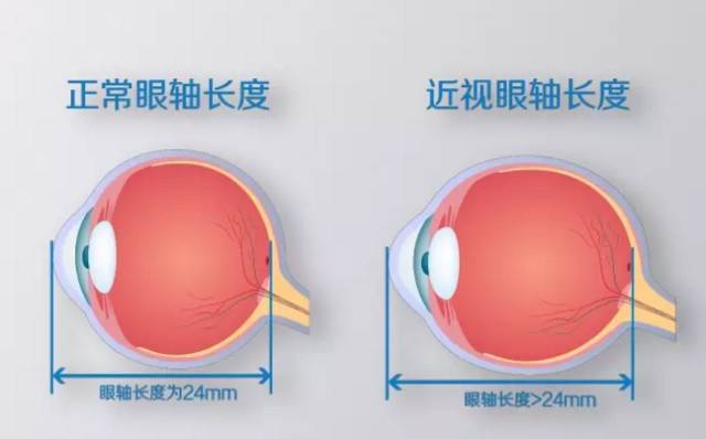 近視不可怕，度數越來越深才可怕