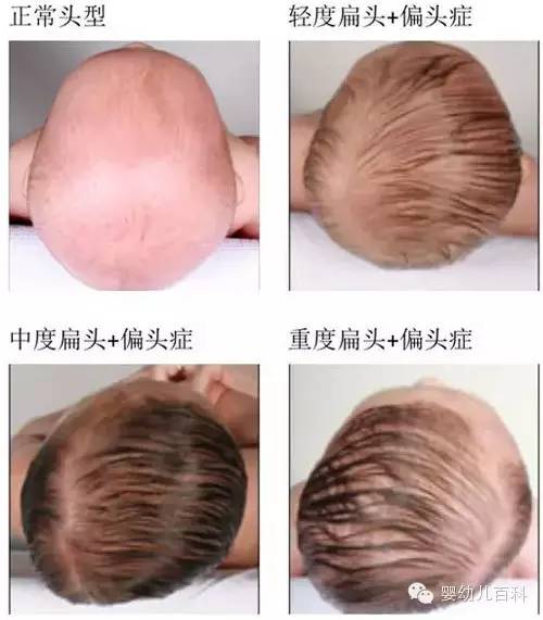 孩子的頭型與睡枕頭有關(guān)系嗎？
