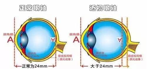 弱視是怎么形成的？它與近視有哪些區別？