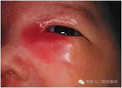 兒童兒淚囊炎的三種發(fā)病原因 兒童兒淚囊炎的三種發(fā)病原因