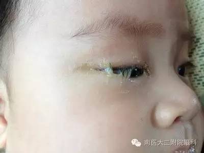 兒童兒淚囊炎的三種發(fā)病原因 兒童兒淚囊炎的三種發(fā)病原因
