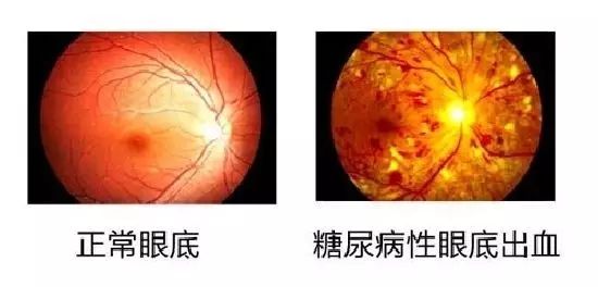 糖尿病會導致眼睛失明，視力模糊是前期征兆！