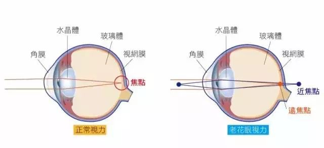 都是視力下降！白內障、老花眼有何不同？