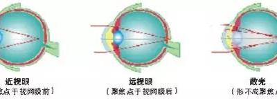 關于散光，這些你都了解嗎？