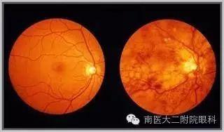 高血壓病人易出現眼底出血