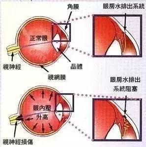 青光眼高發(fā)人群有哪些？