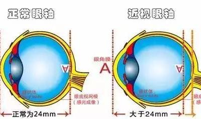 弱視是怎么形成的？它與近視有哪些區(qū)別？