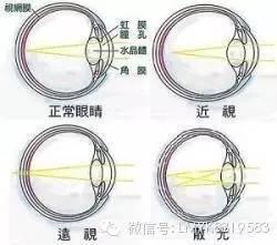 孩子近視+散光了怎么辦?