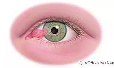 人眼為什么會(huì)長“多肉”？