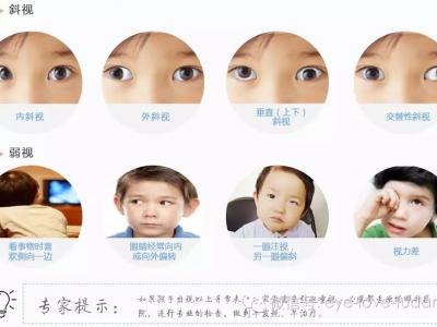孩子斜弱視治療，不要錯(cuò)過關(guān)鍵時(shí)機(jī)