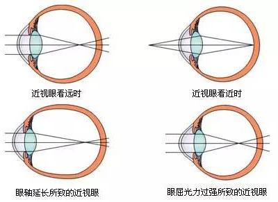 適齡兒童不論視力好壞都應(yīng)該驗(yàn)光