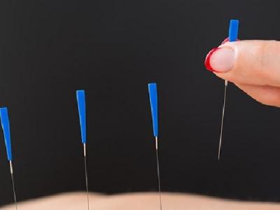 耳鳴耳聾的針灸治療方法是什么 這些針灸療法治耳鳴耳聾效果好