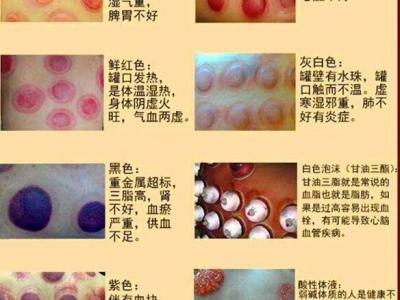 拔罐顏色癥狀對照表圖解，深淺代表不同病癥(越淺越好)