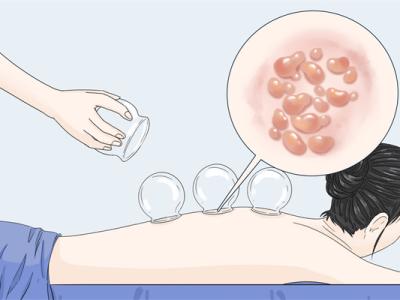 拔罐后可以吹空調嗎